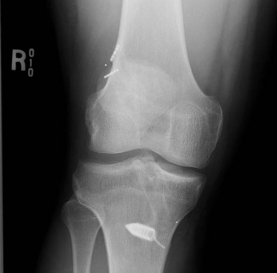 Revison ACL 4 AP Xray